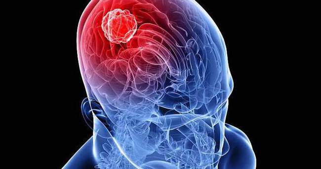 Beyin tümörü belirtileri nelerdir