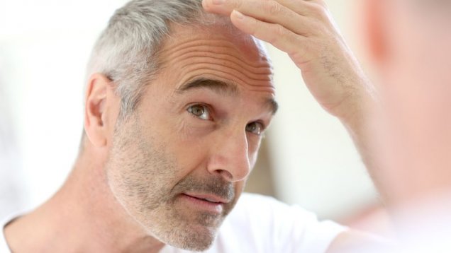 Alopesi Areata Nedir Ne Sebep İle Olur 2018