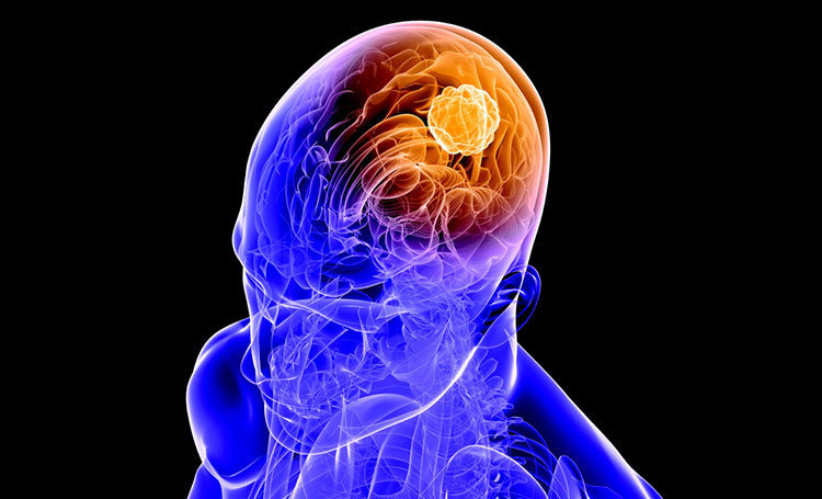 Beyin tümörü tipleri