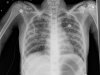 Histoplasmosis Nedir Histoplasmosisin Belirtileri Nelerdir