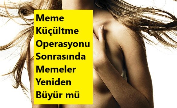 Meme Küçültme Operasyonu Sonrasında Memeler Yeniden Büyür mü