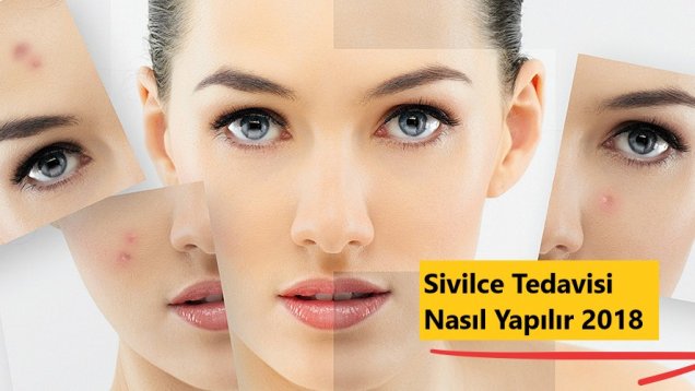 Sivilce Tedavisi Nasıl Yapılır 2018