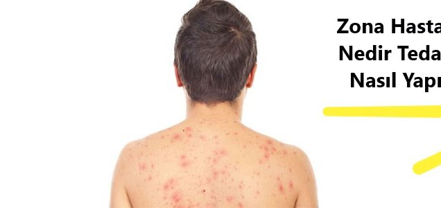 Zona Hastalığı Nedir Tedavisi Nasıl Yapılır
