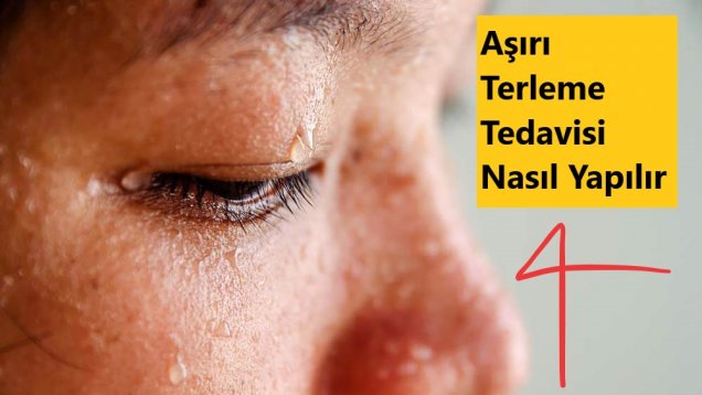 Aşırı Terleme Tedavisi Nasıl Yapılır