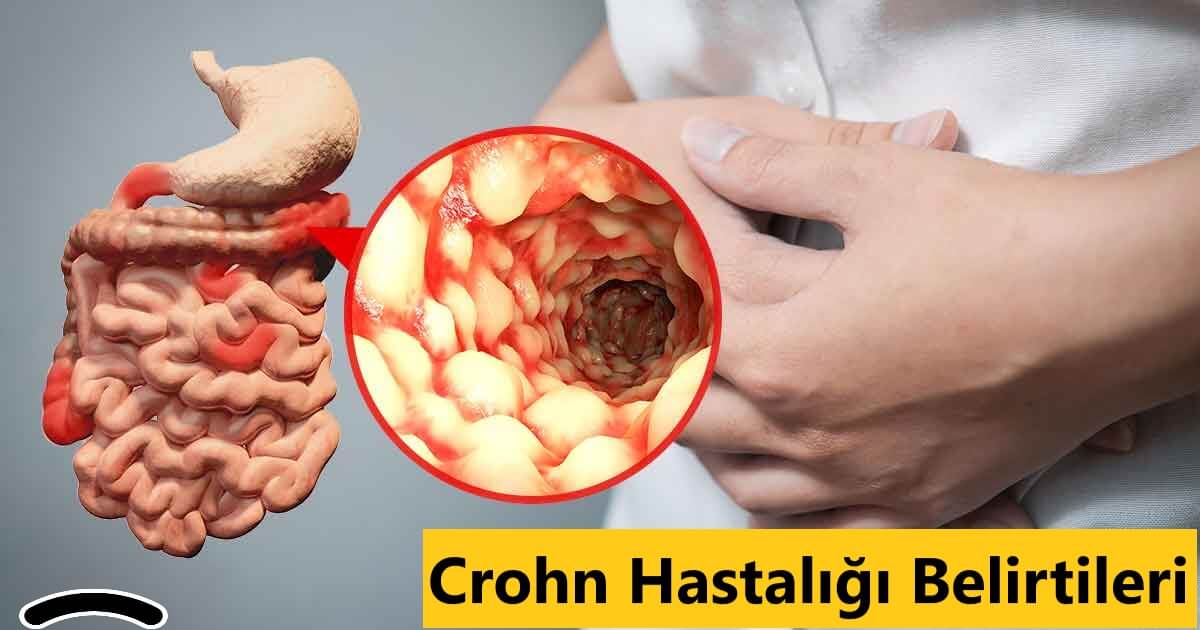 Crohn Hastalığı Belirtileri