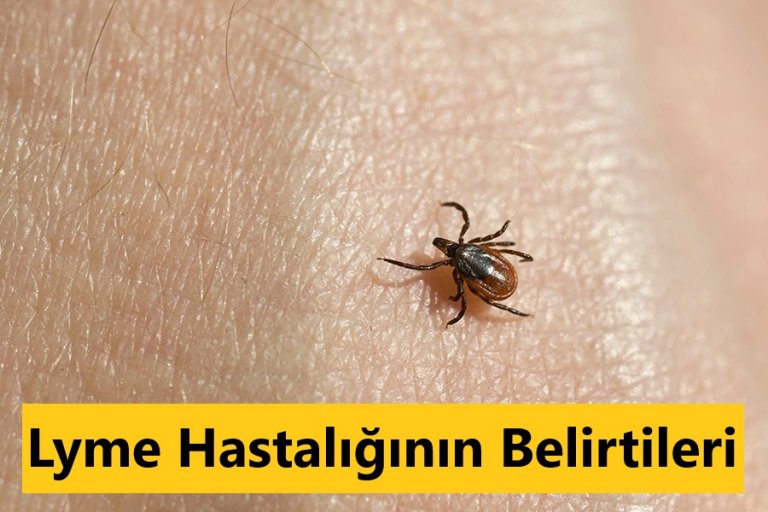 Lyme Hastalığı Nedir? Belirtileri Nelerdir? edoktorTV