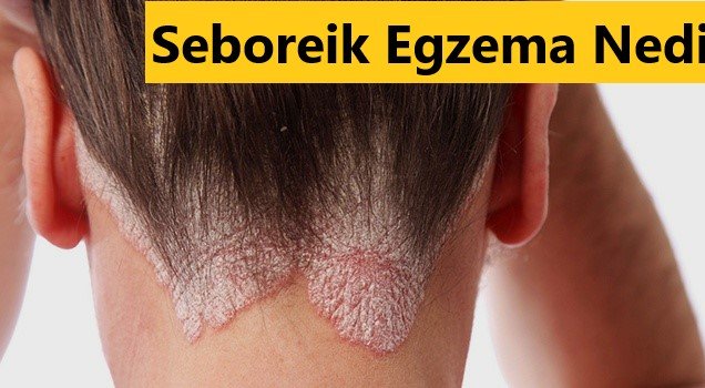 Seboreik Egzema Nedir